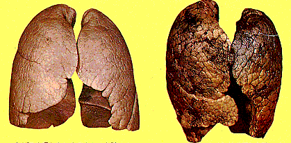 タバコの害による肺の写真